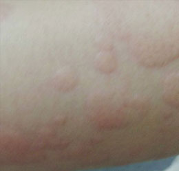 皮炎湿疹患者图片